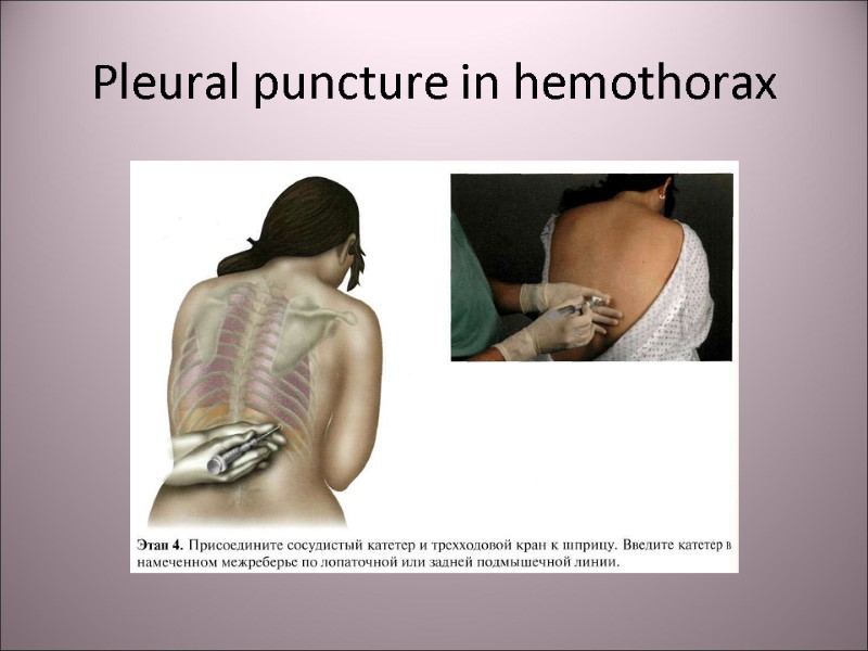 Pleural puncture in hemothorax